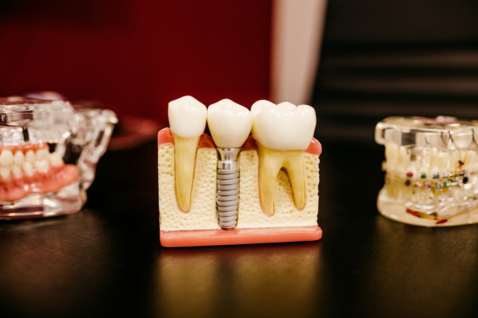 Implante – Happy Dent Center
