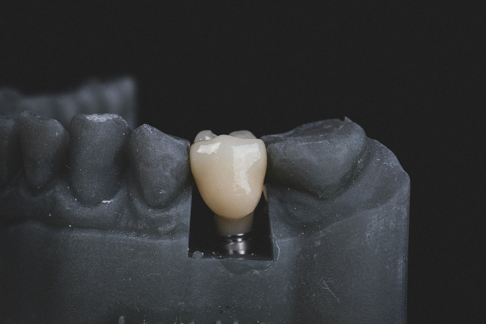 Kurora mbi implante – Happy Dent Center