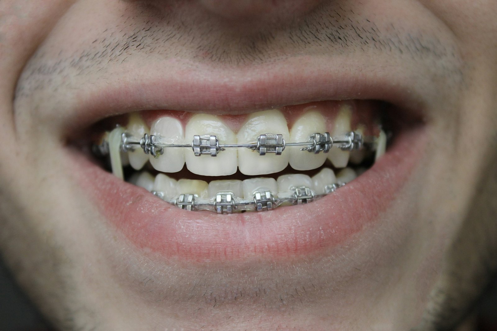 Trajtim ortodontik me aparat fiks – Happy Dent Center
