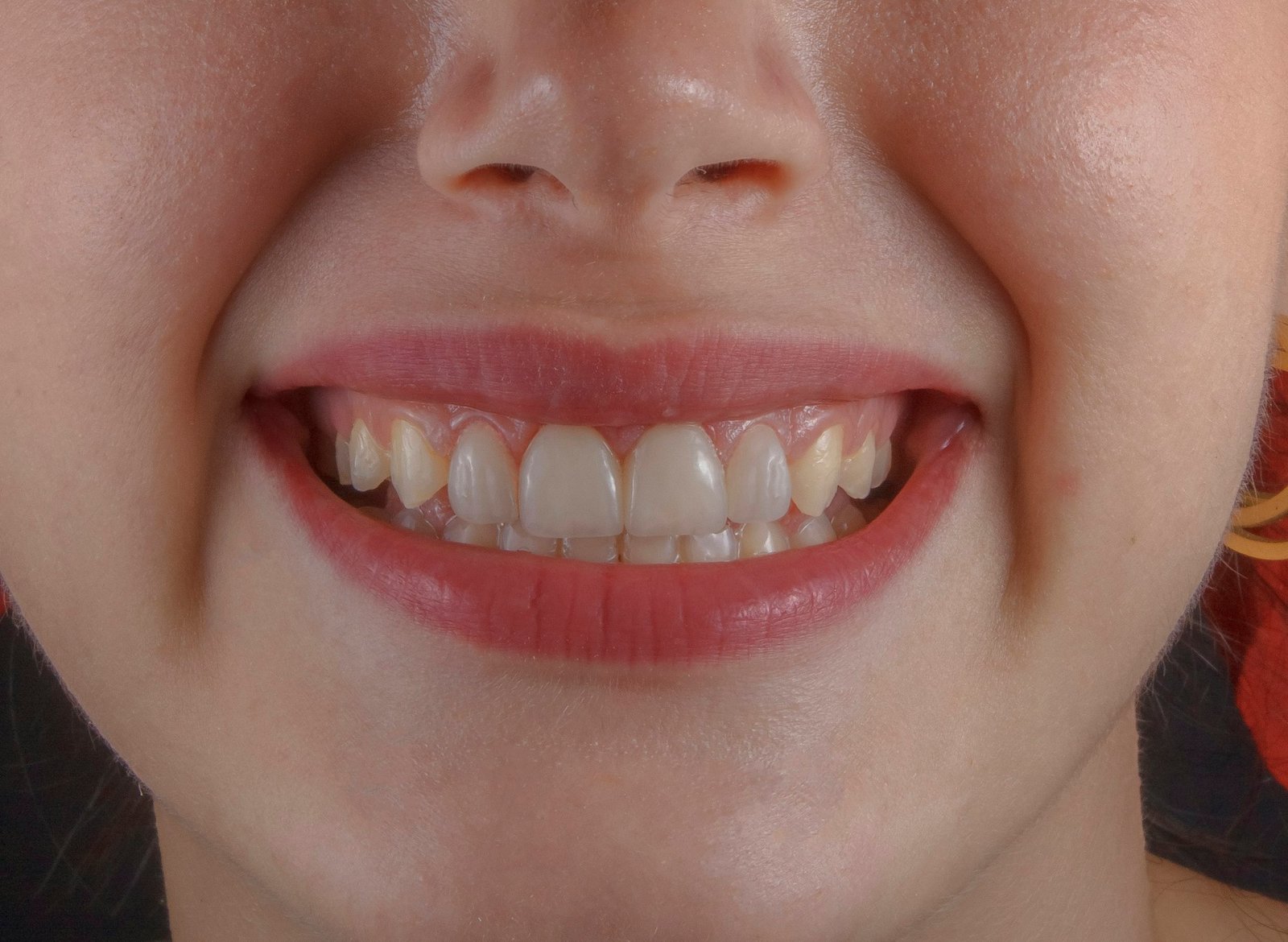 Zbardhim Profesional – Happy Dent Center