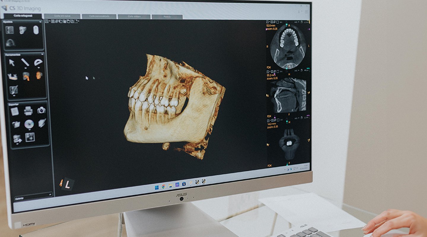 Planifikim 3D i implanteve dentare – Happy Dent Center
